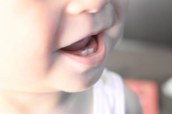 子どもの歯は虫歯になりやすい！？